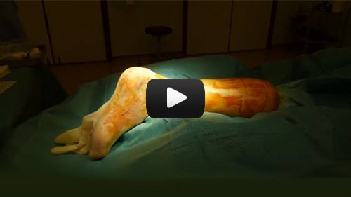 Achilles Tendon Rupture - Surgical Repair 