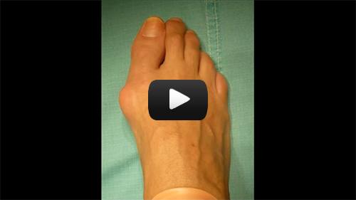 Hallux Valgus (Bunion) Correction