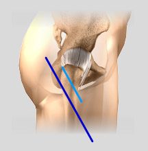 Minimally Invasive Knee Joint Replacement