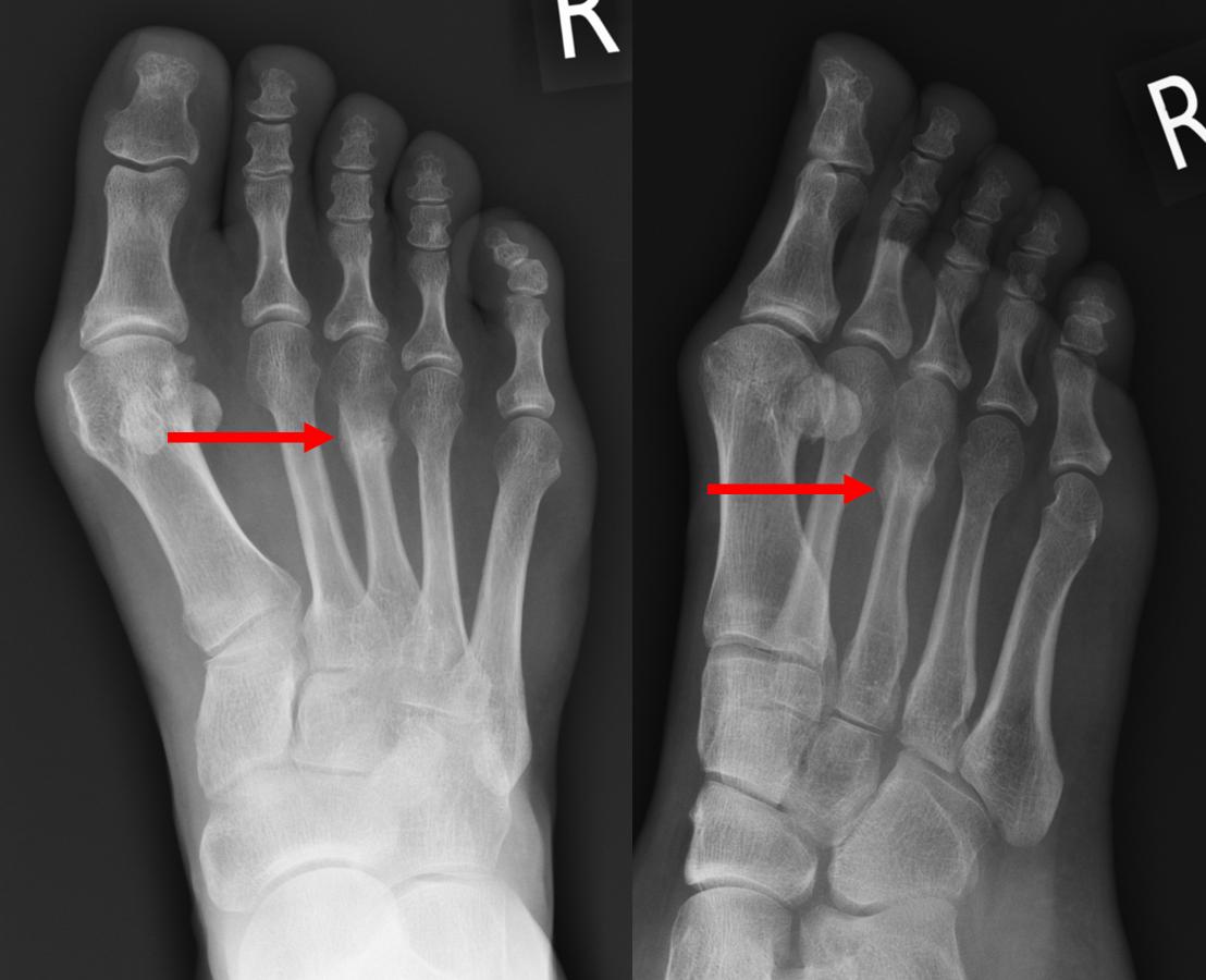 Healing 3rd Metatarsal Stress Fracture