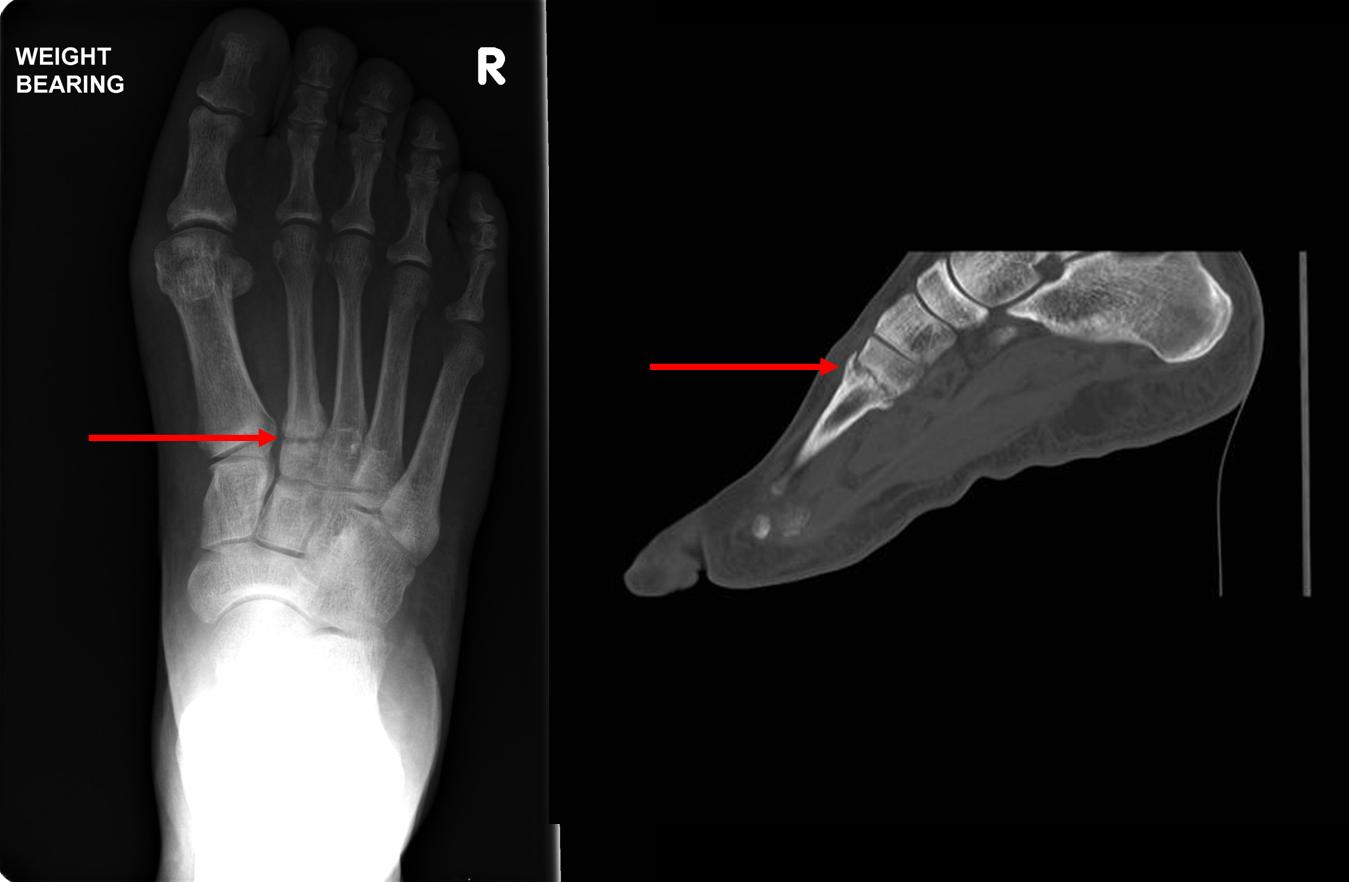 Перелом подошвы. Fracture валорант. Рентген перелома ступни трещина.